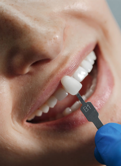 Dental Crowns in Huntingdale Dental Crowns in Huntingdale