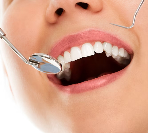Teeth Whitening Dentist Oakleigh Teeth Whitening Dentist Oakleigh