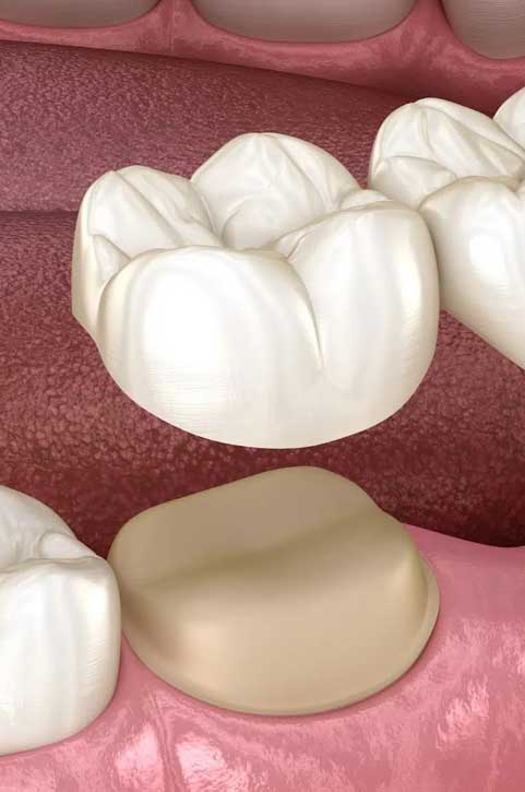 Porcelain Veneer in Huntingdale Porcelain Veneer in Huntingdale