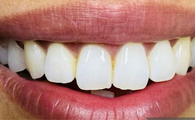 Dental implant after treatment