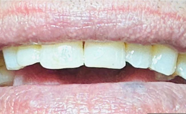 After Tooth Scale & Clean Treatment in Huntingdale