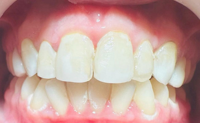 After Dental Implant Treatment