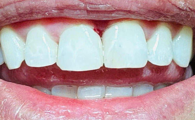 Tooth After Dental Filling