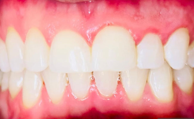 Teeth Whitening Treatment in Melbourne