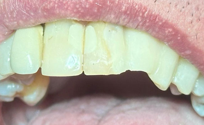 Tooth Whitening Treatment
