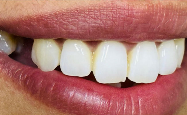 Before Dental Implant