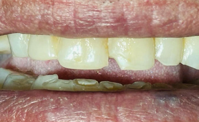 Tooth Before Dental Filling