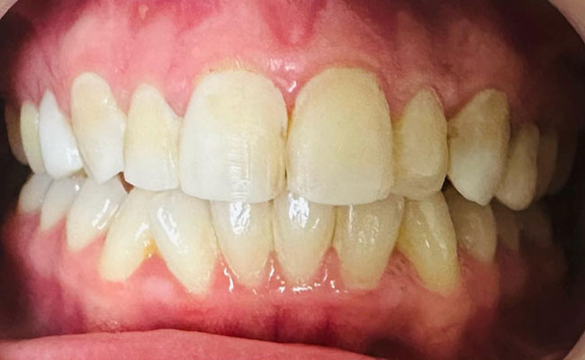 Before Periodontal Treatment Image