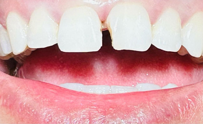 Dental Filling in Melbourne, Victoria