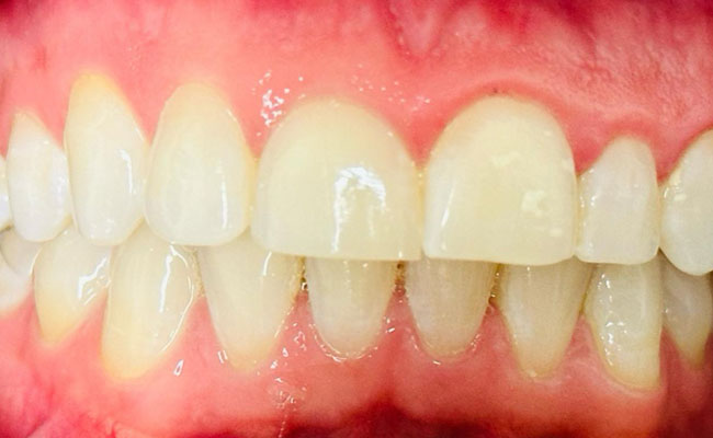 Before Gum Diseases Treatment