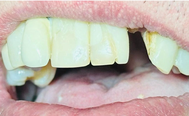 Before Dental Filling