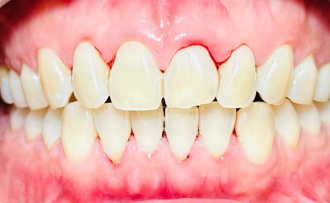Best gum diseases treatment in Melbourne