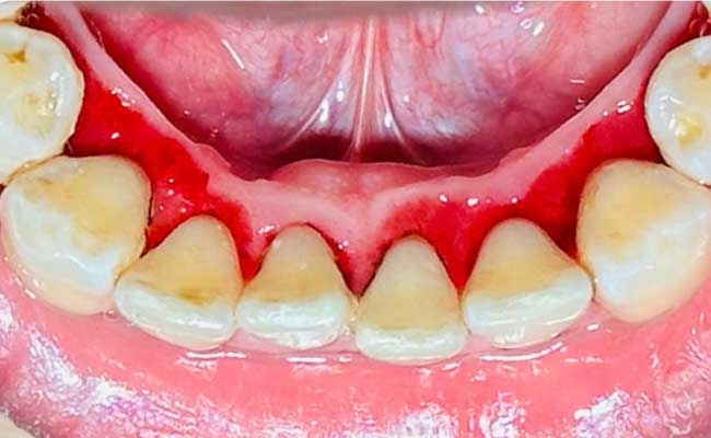 After Periodontal Treatment at Tooth -n-Gum Dental