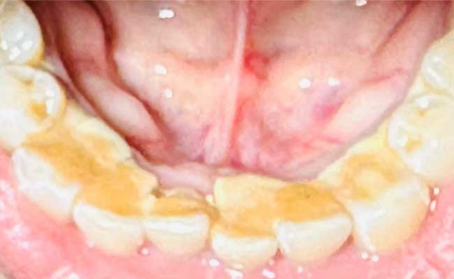 Before Periodontal Gum Diseases Treatment