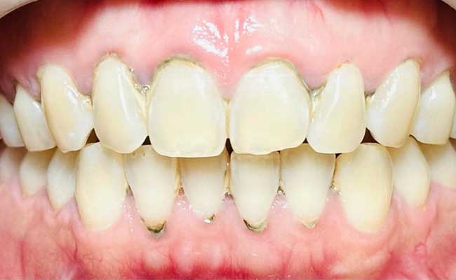Before Periodontal - Tooth-n-Gum Dental