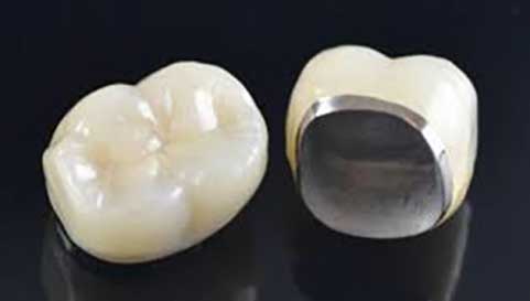 Get quality Dental Crowns at Tooth-n-Gum Dental Get quality Dental Crowns at Tooth-n-Gum Dental