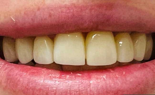 Cosmetic Dentistry Services | Dental Veneers
