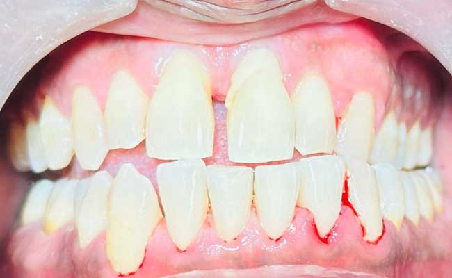 Gum Diseases Treatment - Before & After Image