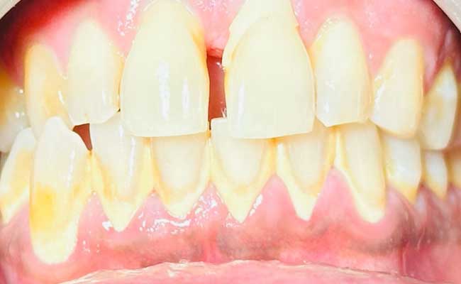 Before Periodontics Treatment