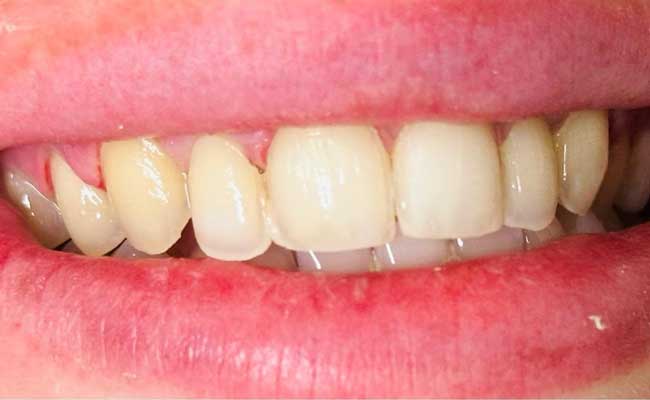 Dental Veneers