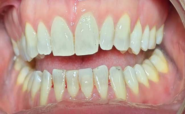 After Teeth Scaling & Cleaning Treatment