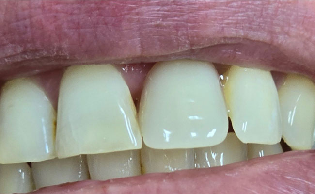 Teeth Scaling & Cleaning in Melbourne
