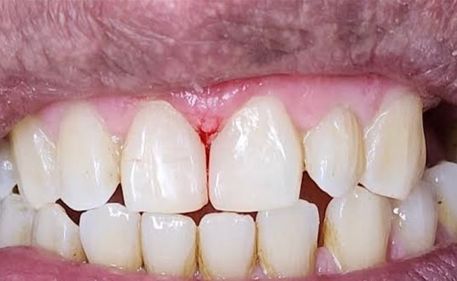 Before & After Periodontal Treatment at Tooth - n-gum Dental