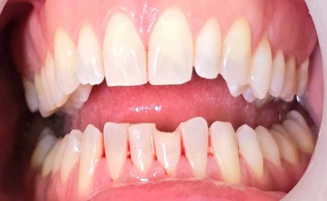 Dental Implants Treatment in Melbourne