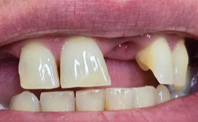 Wisdom Teeth Removal | Tooth -n- Gum Dental