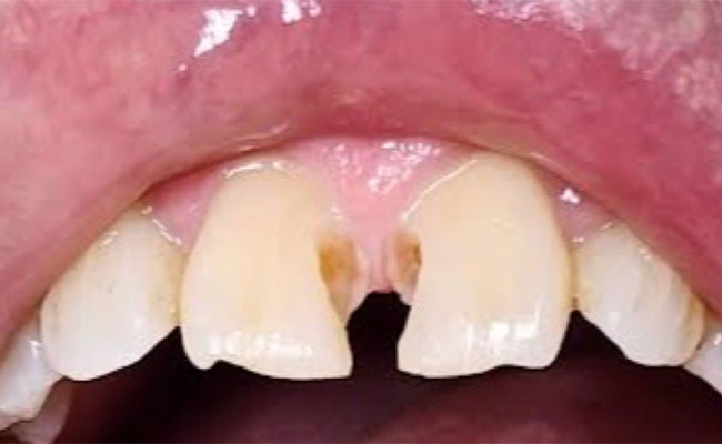 Best Dental Implant in Melbourne