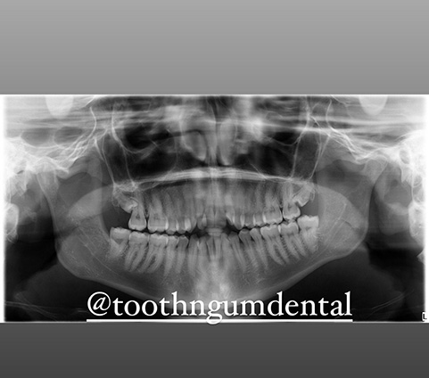 Wisdom Tooth Extraction Wisdom Tooth Extraction