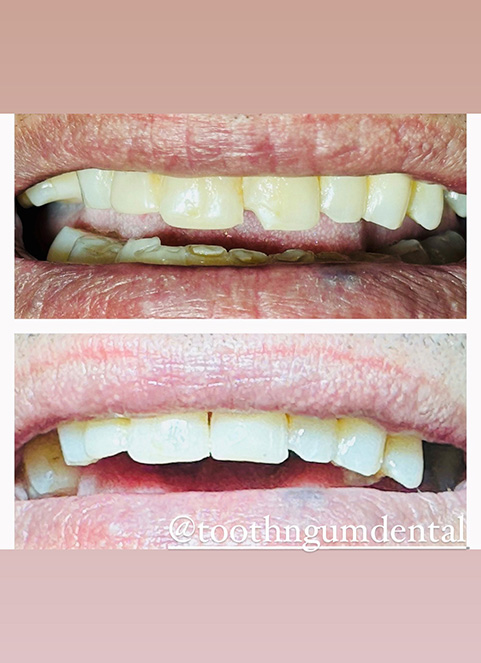Dental Fillings Dental Fillings