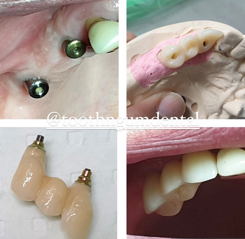 Tooth implant Treatment in Huntingdale Tooth implant Treatment in Huntingdale