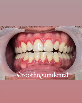 Perio and Gum Disease