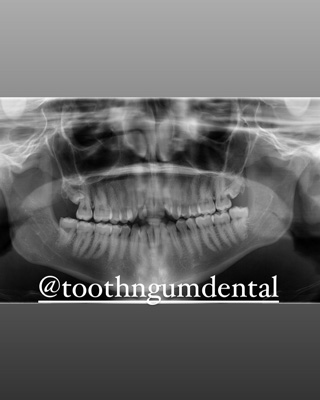 Wisdom Tooth Extraction