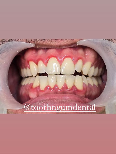 periodontal periodontal