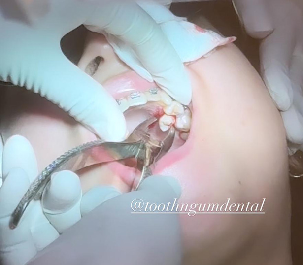 Tooth Extraction Tooth Extraction
