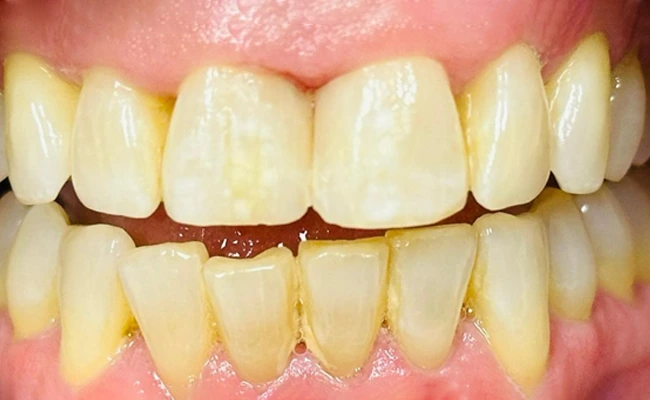 Early signs of gingivitis