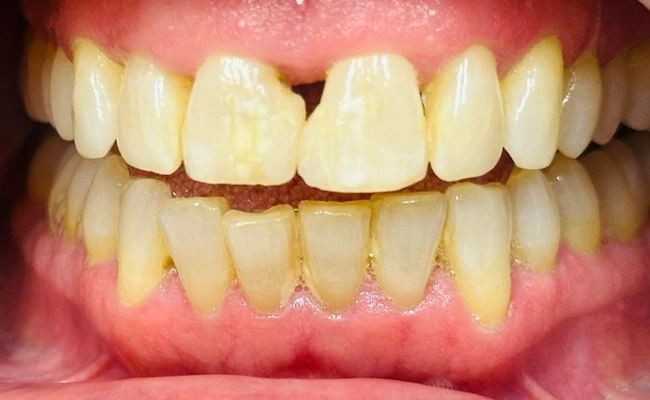 Yellow Teeth Tartar Buildup