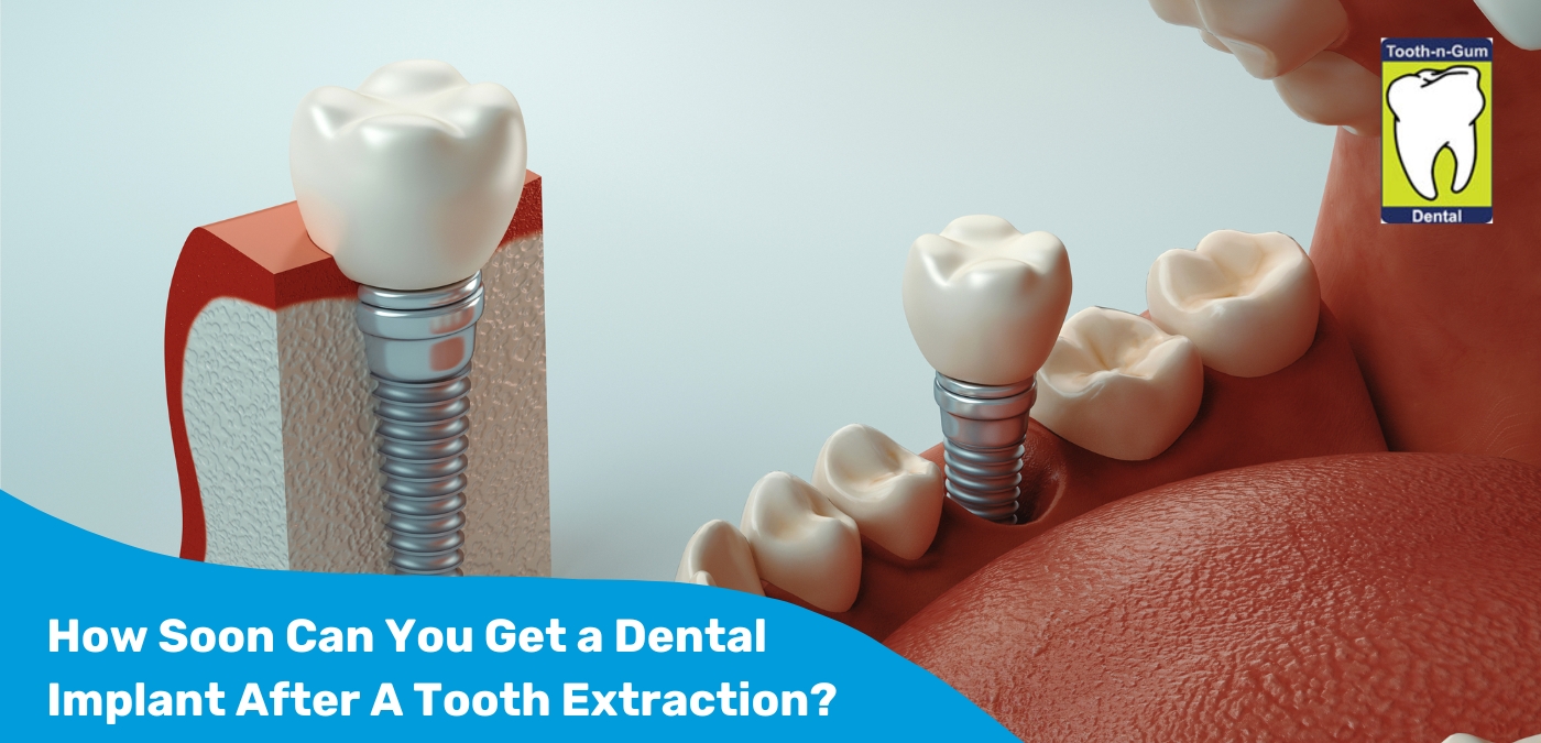 How Soon Can You Get a Dental Implant After A Tooth Extraction How Soon Can You Get a Dental Implant After A Tooth Extraction