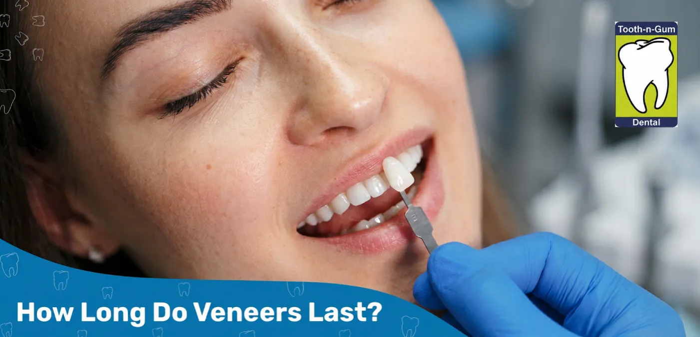 How Long Do Veneers Last How Long Do Veneers Last