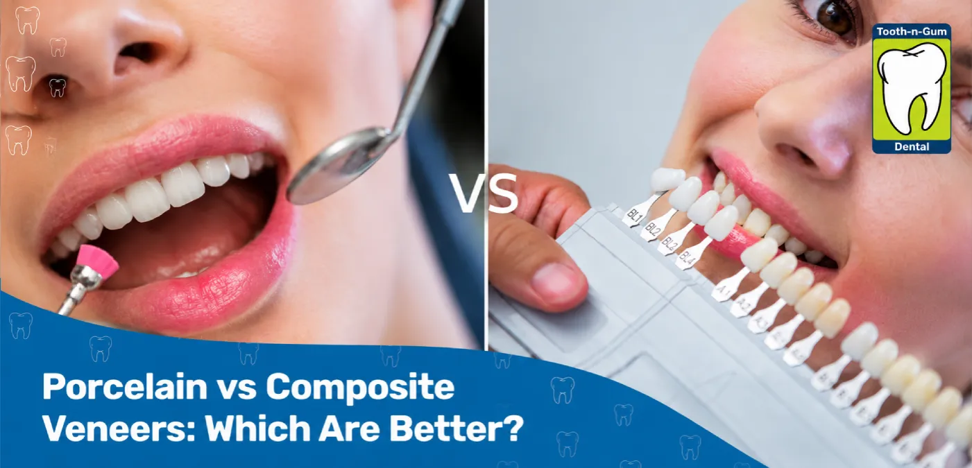 Porcelain vs Composite Veneers